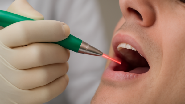 Lasersko lečenje parodontopatije: Kompletan vodič za pacijente