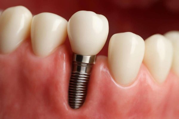 Funkcionalnost zubnih implantata: Šta očekivati?