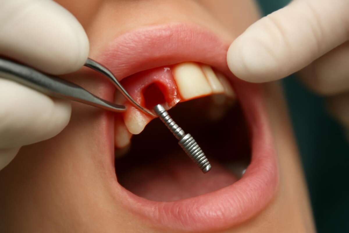 imedijatna implantacija