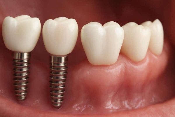 prednosti zubnih implantata