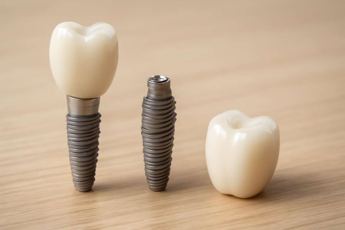bezbolnost ugradnje zubnih implantata