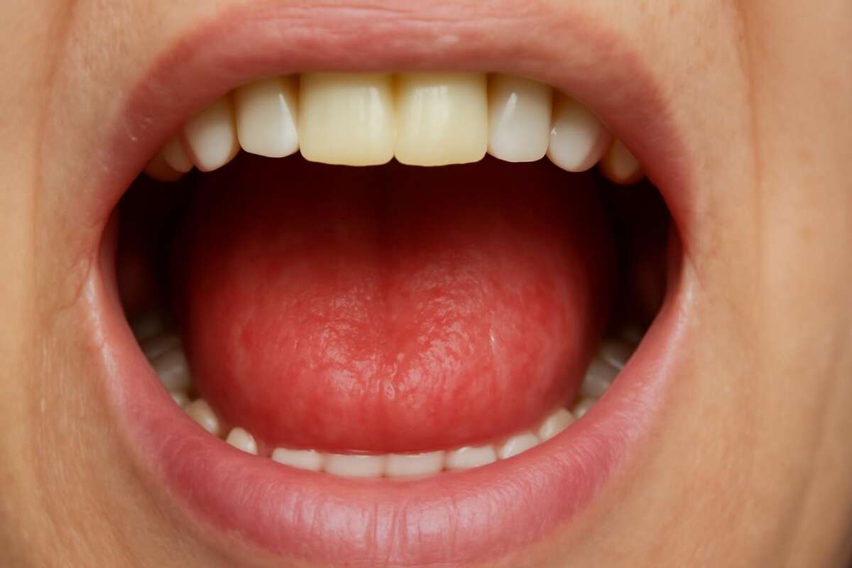 protetski stomatitis