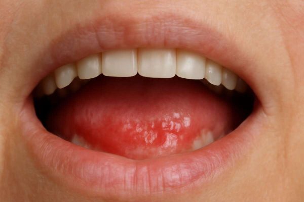 Protetski stomatitis: Vodič za pacijente