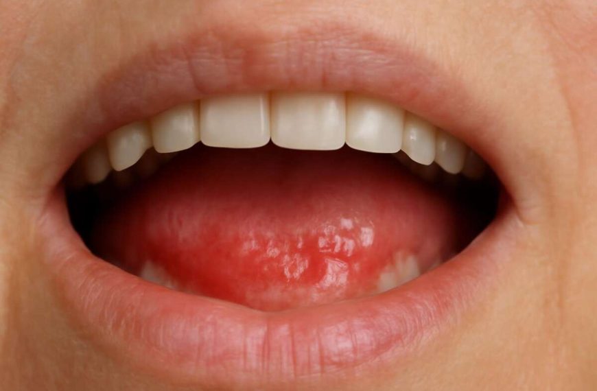 Protetski stomatitis: Vodič za pacijente