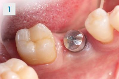 Dentalni implantati dr Lazar lavin beograd