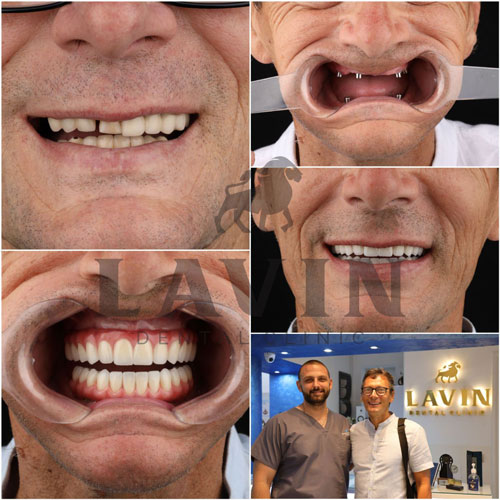 all on 4/6 koncept zubni implanti