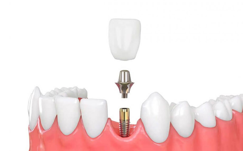 Dentalni implanti - šta možete očekivati? blog