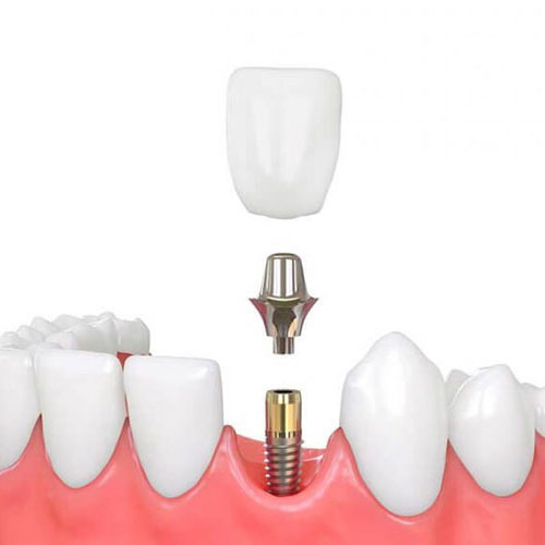 Dentalni implanti blog lavin beograd